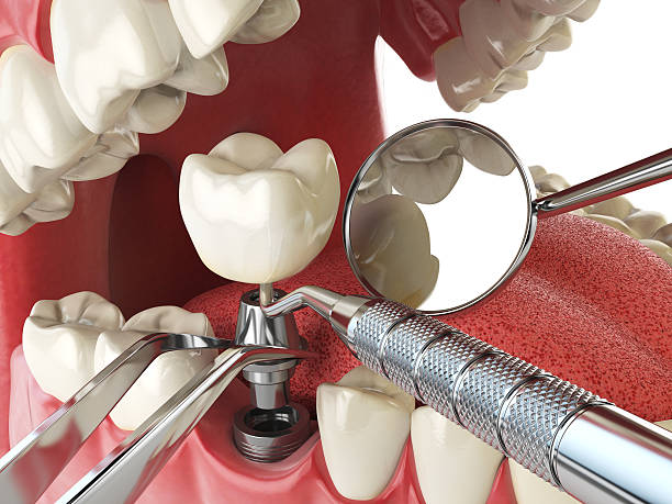 Best Knocked-Out Tooth (Avulsed Tooth) Treatment in Dunmore, PA